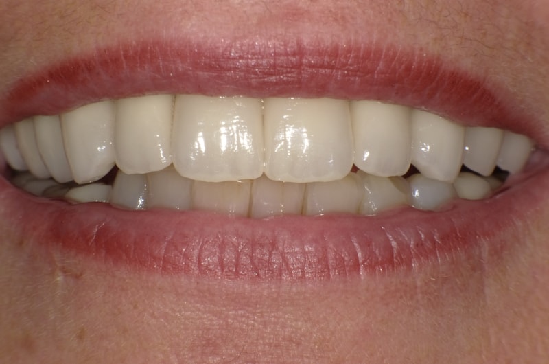 Optimierung von Zähnen und Zahnleisch mit Vollkeramik